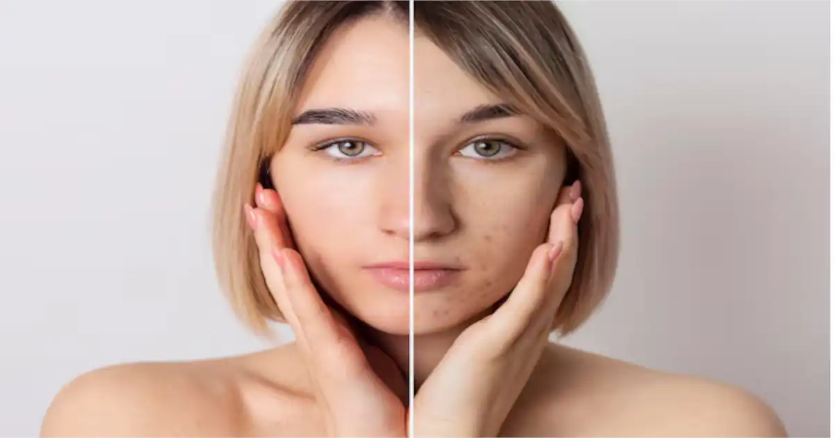 Hyperpigmentation: Causes, Treatment, and Prevention